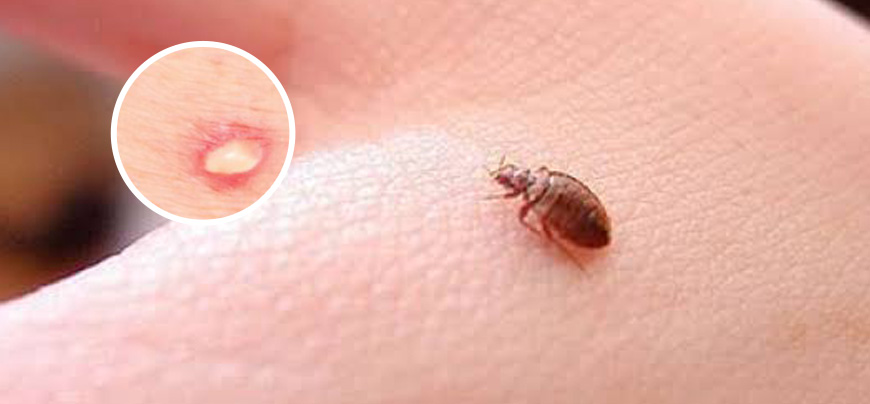 Pest Control Bed Bugs 